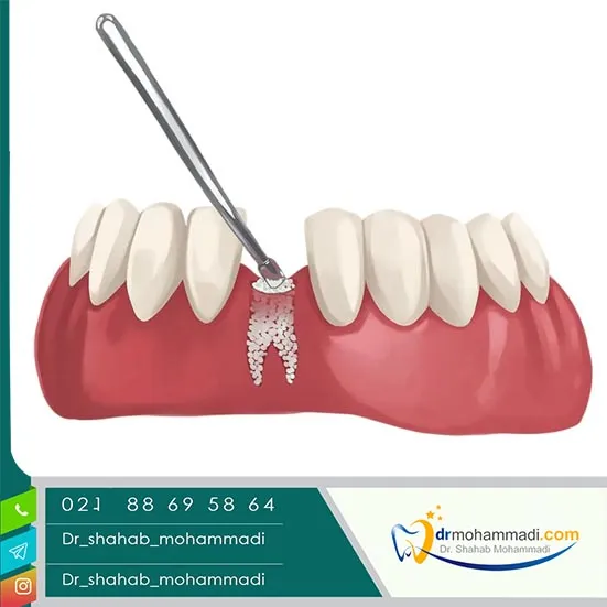 کیا پیوند استخوان فک انجام دادن